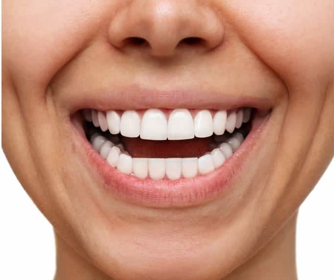 Teeth Whitening - After